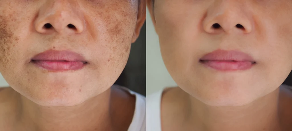 How Laser Technology Targets and Reduces Pigmentation